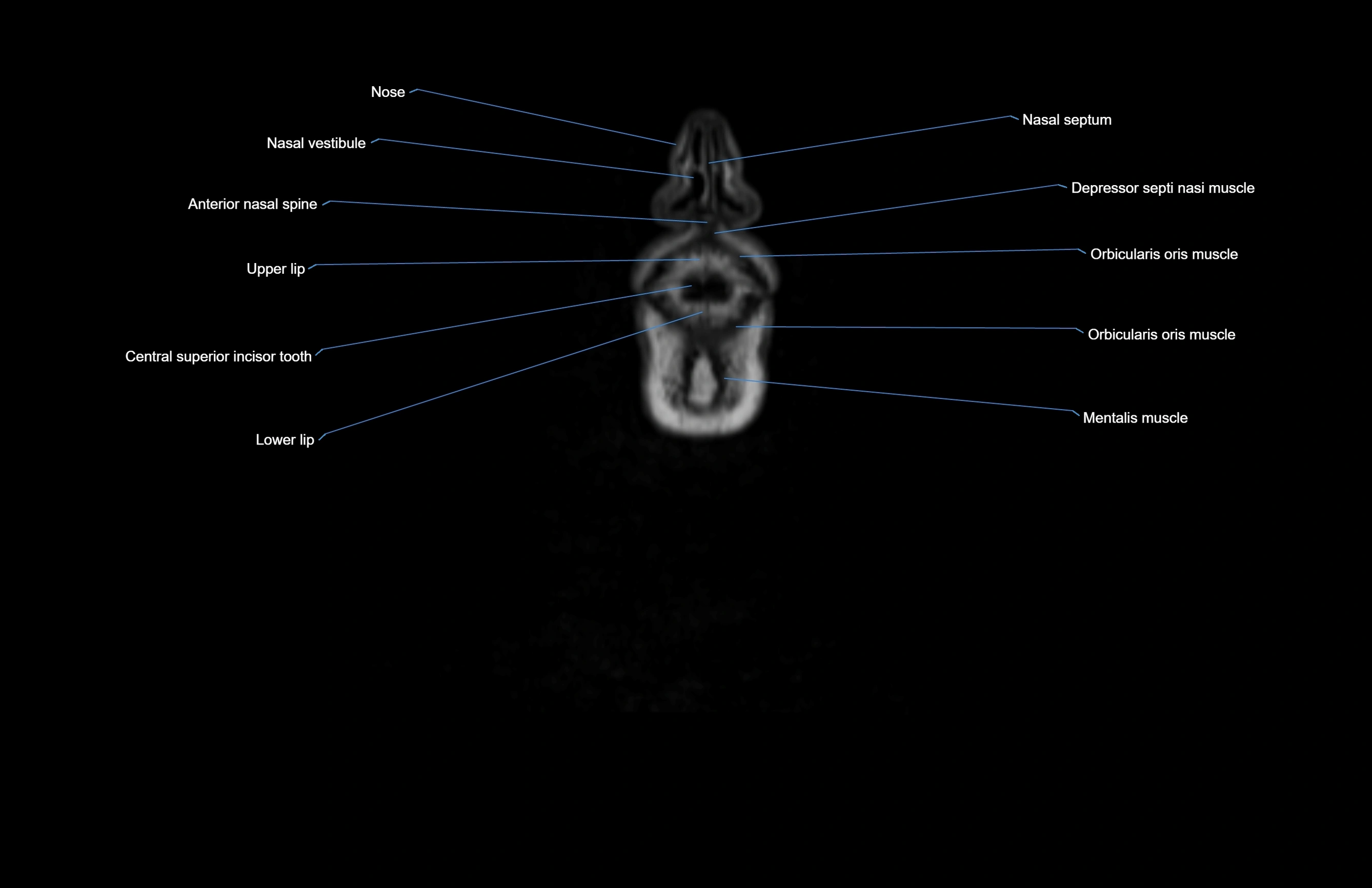 Neck coronal cross sectional MRI anatomy 3T MRI  image-img-00001-00079.webp